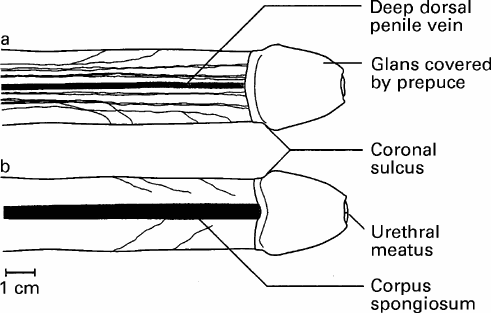 Sulcus Of Glans Penis