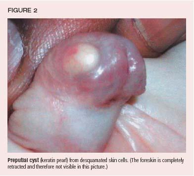 pictures of penis cysts