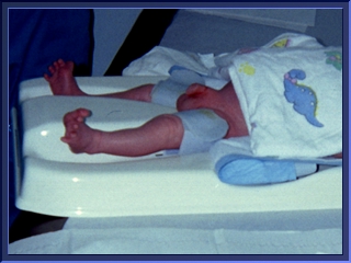 Photo essay of infant circumcision