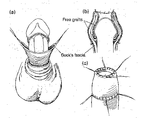 Permanent Infibulation Male