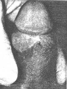 photograph showing dorsal view of circumcised penis