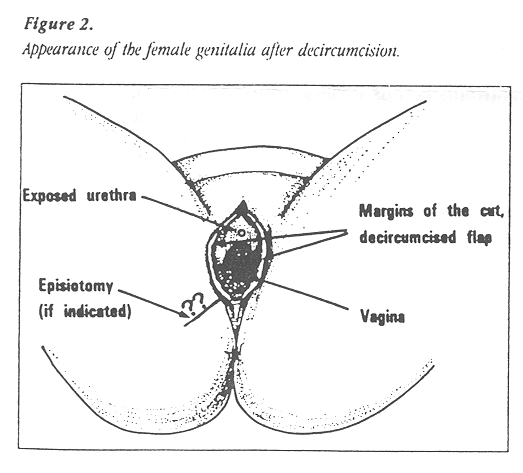Circed woman female circumcison and infibulation