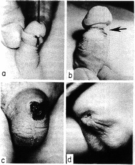 four complications of circumcision