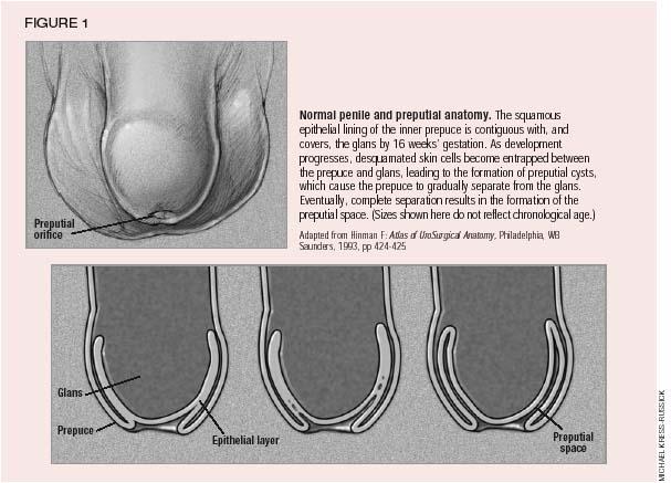 Figure 1 from Pathologic and physiologic phimosis: approach to the phimotic  foreskin.