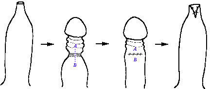 Surgical Techniques: Dorsal Slit Surgery for Clitoral Phimosis