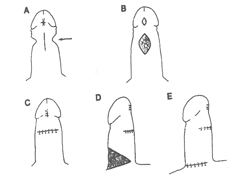 Five line drawings illustrating five stages of surgical procedure.