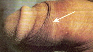 Photo of ridged band